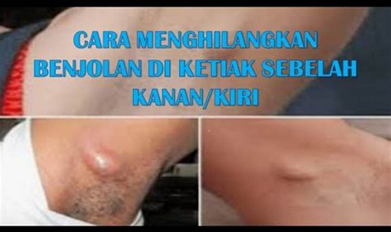 Cara Mengatasi Benjolan Di Ketiak Cara Mengatasi Benjolan Di Ketiak